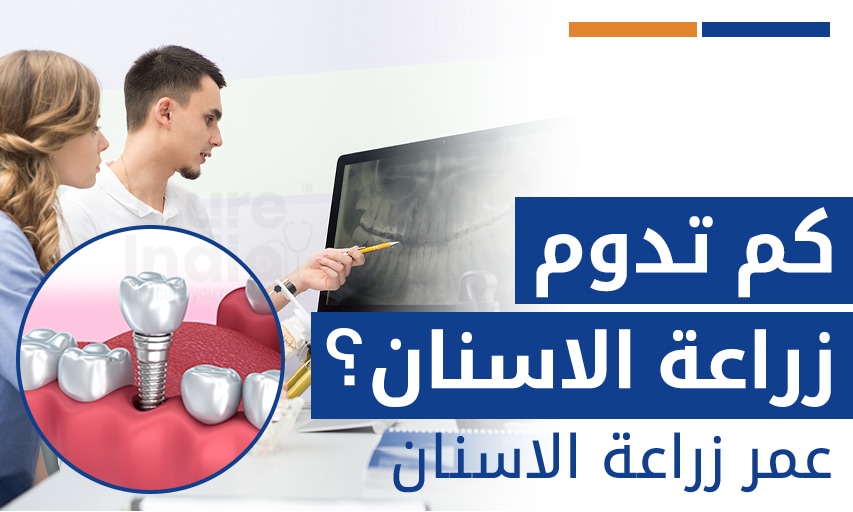 كم تدوم زراعة الاسنان؟ عمر زراعة الاسنان